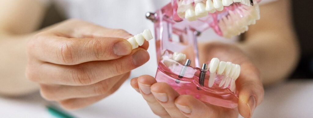 Modell zeigt Haltbarkeit eines Zahnimplantats
